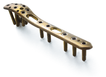 5.0ChLP Distal Lateral Fibula Plate