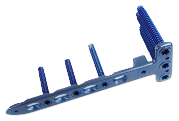 7.0ChLP Opening Wedge Osteotomy